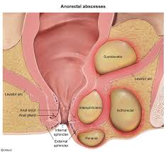 Image result for Perirectal Abscess