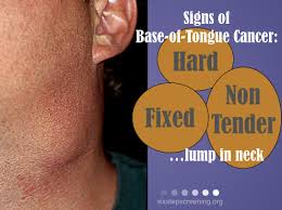 Why oral cancer has a high death rate. Six Steps To A Thorough Oral Cancer Screening Six Step Screening