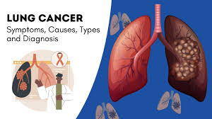 Image result for Lung Cancer