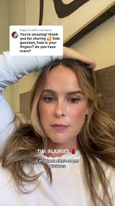 Replying to @Kelli they're adorned with diamonds for taking the hit for me  that night #fyp #injury #fyppppppppppppppppppppppp #recovery