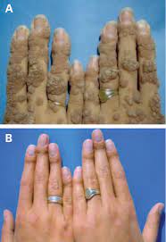Most warts resolve within four to six months. Complete Remission Of Recalcitrant Viral Warts Under Oral Isotretinoin In A Patient With Low Grade B Cell Lymphoma Semantic Scholar