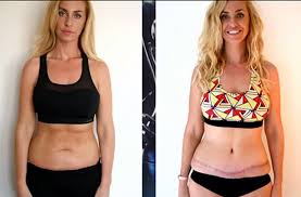 Josie gibson news, gossip, photos of josie gibson, biography, josie gibson boyfriend list 2016. Josie Gibson Reveals She May Never Have Children After Undergoing Tummy Tuck To Remove Excess Skin