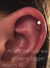 Piercing Bump 6 Ways To Get Rid Of Cartilage Or Nose Keloid Blister
