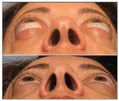 Management Of Thyroid Eye Disease