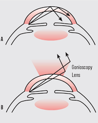 Image result for Gonioscopy
