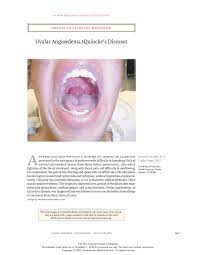 Pdf Images In Clinical Medicine Uvular Angioedema Quincke S Disease