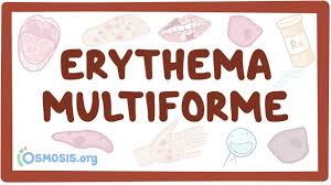 Image result for Erythema Multiforme Major