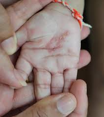 Image result for scabies human children