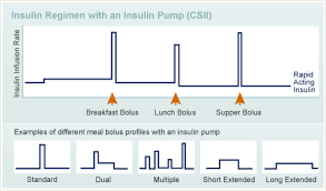 programming your pump diabetes education online