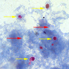 Cryptosporidiosis is a diarrheal disease caused by microscopic parasites, cryptosporidium, that can live in the intestine of humans and animals and is passed in the stool of an infected person or animal.both the disease and the parasite are commonly known as crypto. the parasite is protected by an outer shell that allows it to survive outside the body for long periods of time and makes it. Cdc Dpdx Cryptosporidiosis