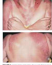 Image result for Photodermatitis
