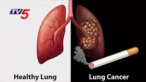 Electronic cigarettes produce an aerosol by heating a liquid that usually contains nicotine—the addictive drug in regular. Lung Cancer Causes Symptoms Treatments Omega Hospital Health File Telugu News Tv5 News Youtube