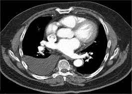 It is usually symptomatic and is commonly associated with a malignant cause.20 the diagnosis of a malignant pleural effusion is discussed in the guideline on the investigation of a unilateral pleural effusion. Pleural Effusion Pacs Suche Fur Radiologen