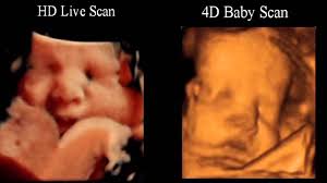 Compare A Movie Of An Hd Live Scan And Standard 4d Baby Scan At Http Www Babyscanning Co U Baby Scan 16 Weeks Pregnant Ultrasound 6 Weeks Pregnant Ultrasound