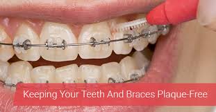 This is especially true if the spots occur after taking off braces, which means they were not being properly cleaned. How To Get Rid Of Plaque While Wearing Braces David Silberman Dds