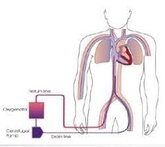 Patient selection criteria, cannulation and decannulation strategies, transport. Extracorporeal Membrane Oxygenation Litfl Ccc