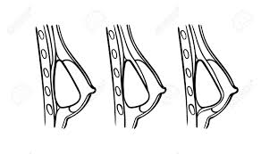 Illustration Of Plastic Surgery Types Breast Implants Positions