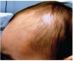 Image result for Tinea Capitis