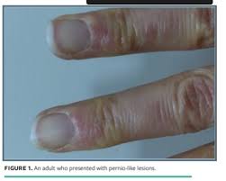 Clinical signs include fever, rash, swelling of the hands and feet. Cutaneous Manifestation During Covid 19 Don T Let The Rash Fool You Wound Management Prevention