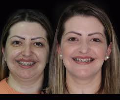 Marcello Piacentini Odontologia Especializada