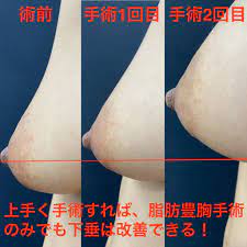 垂れ乳（乳房下垂）と豊胸手術 | 脂肪豊胸専門の銀座3丁目•BANNAI美容クリニック