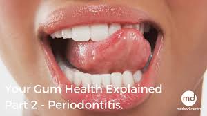 Periodontal disease, also called periodontitis, is common. Periodontitis Gum Disease And How To Treat It Method Dental