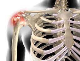 Schulterschmerzen Symptome Verletzung Sehnenruptur Arthrose Oder Entzundung Www Gelenk Doktor De