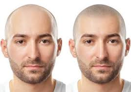 Quality that goes into scalp micropigmentation cost . Scalp Micropigmentation Palm Desert Palm Desert Scalp Micro Pigmentation