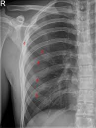 They articulate with the vertebral column posteriorly, and they also have a role in ventilation; Bifid Rib Wikipedia