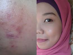 3 cara menghilangkan jerawat secara alami dan cepat. Cara Hilangkan Bekas Jerawat Berbagi Cara