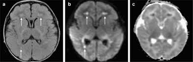 Despite advances in antiviral therapy over the past 2 decades, herpes simplex encephalitis (hse) remains a serious illness with significant risks of morbidity and death. Neuroimaging Of Herpesvirus Infections In Children Springerlink