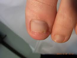 足 の 爪 切り すぎ