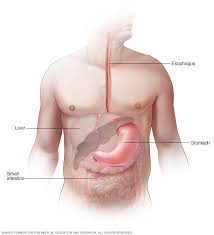 It can feel like the food is stuck in the throat or chest, and can even cause someone to choke on their food. Esophageal Cancer Symptoms And Causes Mayo Clinic