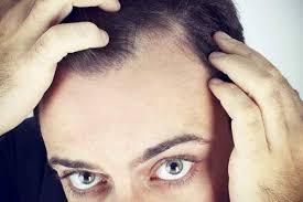 Hair loss has many causes. It S The Question That Brings A Sense Of Dread To Any Beer Lover Whisky Swigger Or Cocktail Sipper Can Hair Loss Men Oil For Hair Loss What Causes Hair Loss