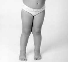 Image result for Genu Varum