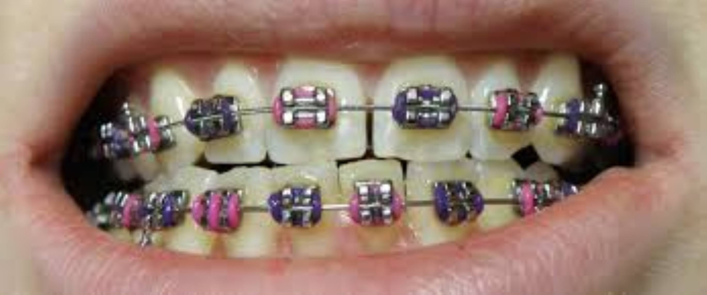 Ceramic Dental Braces product image