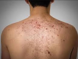 Veja Como Evitar E Tratar Acne Nas Costas Que E Um Drama Para Varias Pessoas Truques Nota 10 Acne Nas Costas Espinhas Cicatriz De Acne