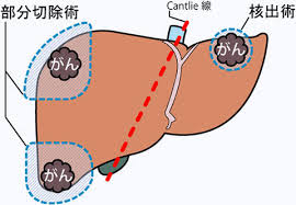 肝臓の手術 肝臓の病気と治療 東京医科歯科大学肝胆膵外科