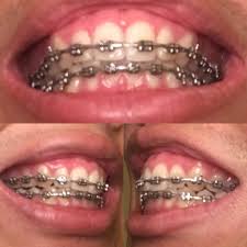 How long does/did/will it take to do something? Do My Teeth Look Ready Getting My Braces Off In July Braces