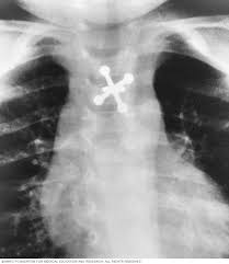 Also, people who smoked for less than 10 years may do better. X Ray Imaging Test Quickly Helps Diagnosis Mayo Clinic