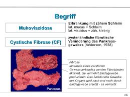 Die mukoviszidose, auch als zystische fibrose (engl. Einfuhrung Cystische Fibrose