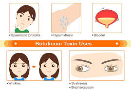 Early symptoms include marked fatigue, weakness and vertigo, usually followed by blurred vision, dry mouth and difficulty in swallowing and speaking. Botulinum Toxin The Definitive Guide Biology Dictionary