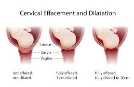 How the 3 statements link together and how to walk through questions where one or multiple items change. Cervical Effacement What You Need To Know