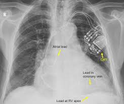 Almost all icds these days also come with pacemaker capabilities as well. Cardiac Implantable Electronic Devices Cied On Cxr
