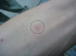 Image result for spinne biss haut reaktion