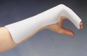 Image result for Radial Gutter Cast
