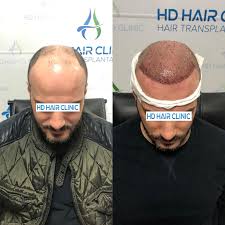 6300 Greft Ekimi Ile Max Sayi Natural On Cizgi Ve Profesyonel Ekibin Ellerinde Bizimle Guvendesiniz الان في مركز اسطنبول لزراعة الشع Hair Clinic Clinic Hair