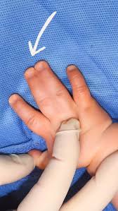 Image result for Syndactyly