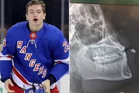 Vesey (born may 26, 1993) is an american ice hockey left winger. Gruesome Injury Won T Keep Jimmy Vesey Out Of Lineup
