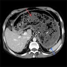 Image result for Bezoar